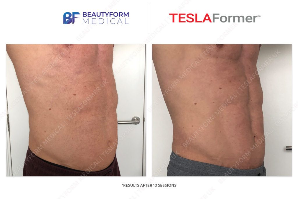 TeslaFormer-B&A-10sessions-45degree