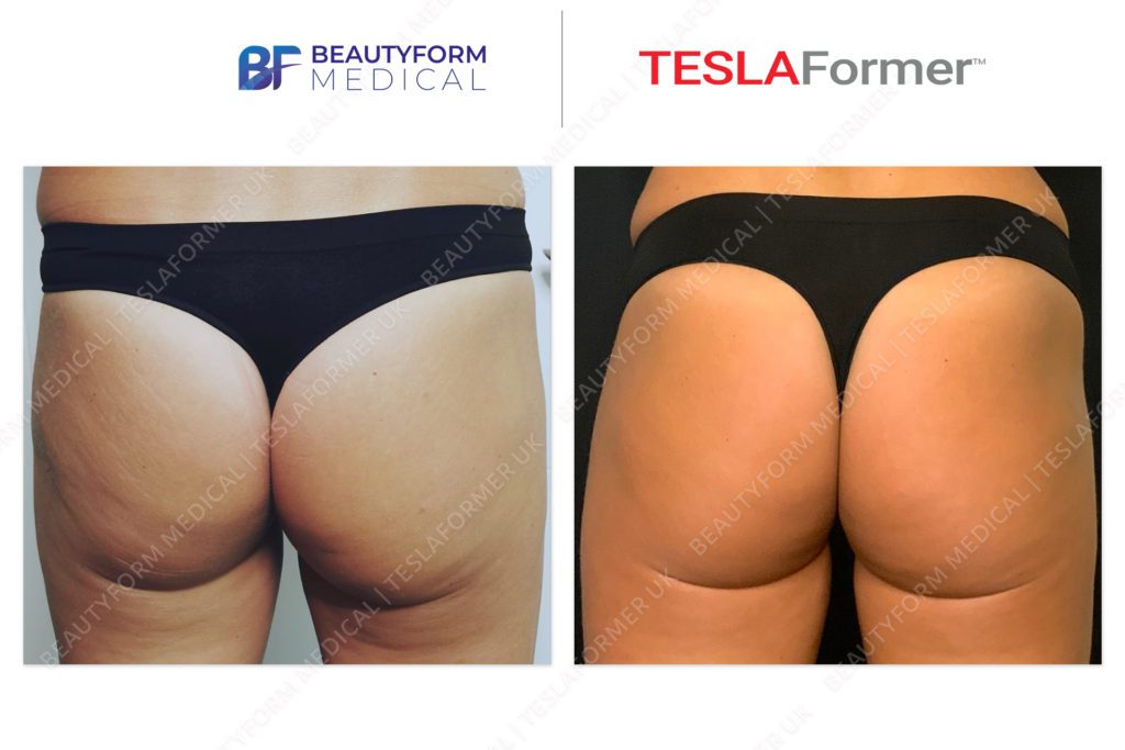 TeslaFormer-B&A-glutes
