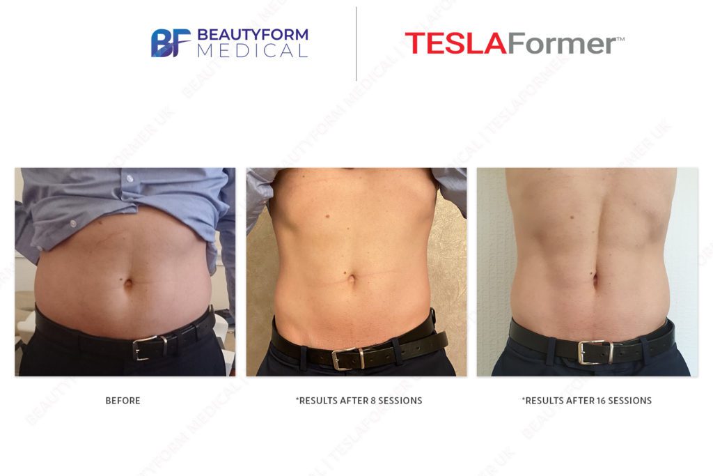 TeslaFormer-Beforeafter-2