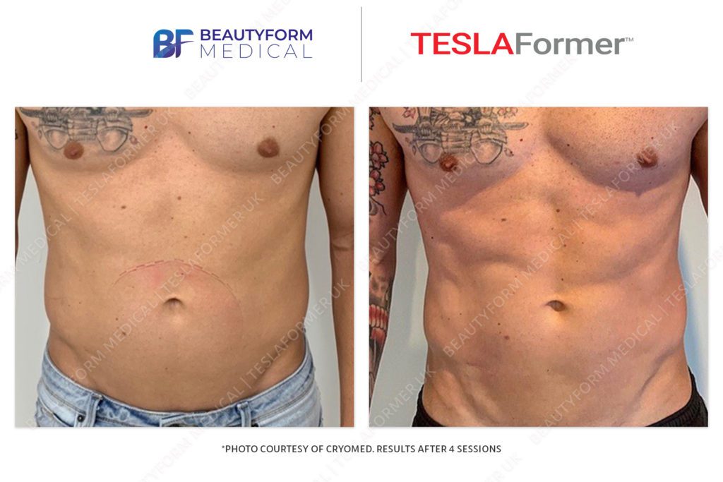 TeslaFormer-Beforeafter-3