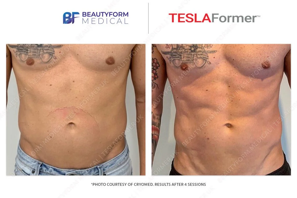 TeslaFormer-Beforeafter-3