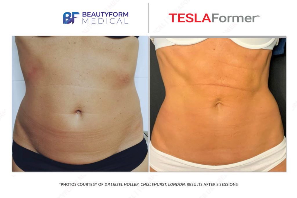 TeslaFormer-Beforeafter-DrLieselHoller-1