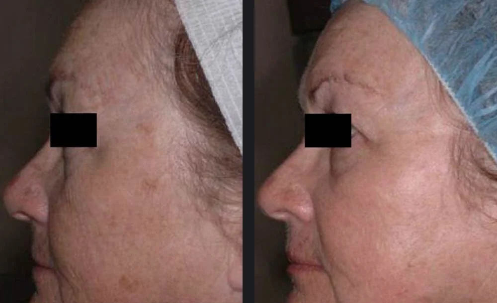 co2re-skin-resurfacing-e-vic-ross_8AnPpPe